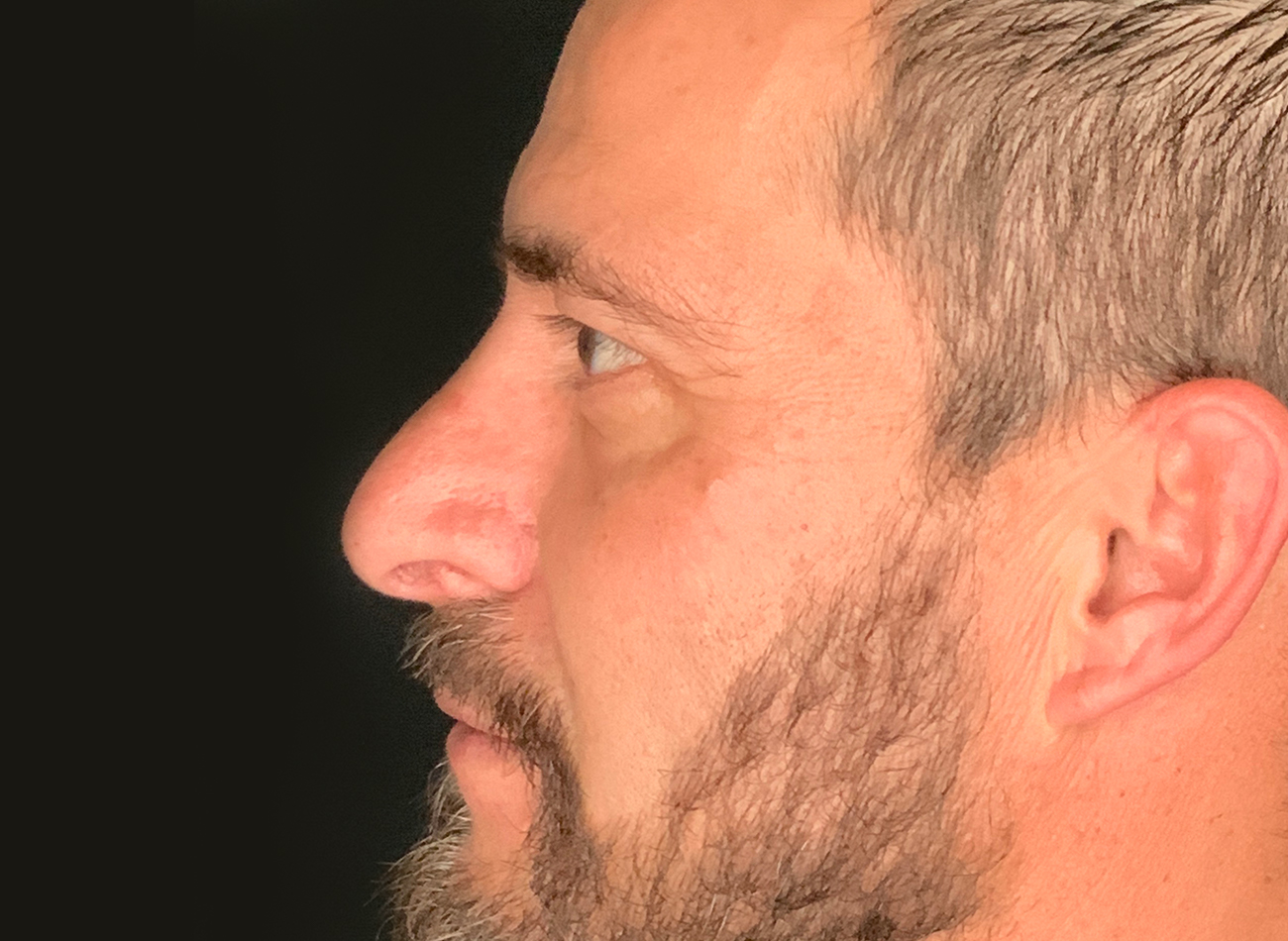 Patient #11645: Rhinoplasty After Image