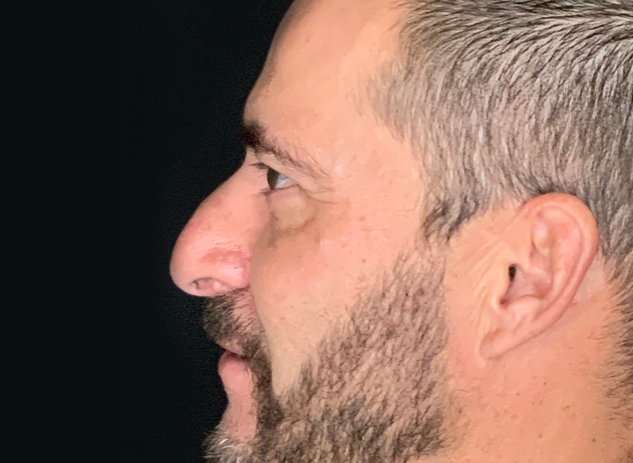 Patient #11645: Rhinoplasty Before Image