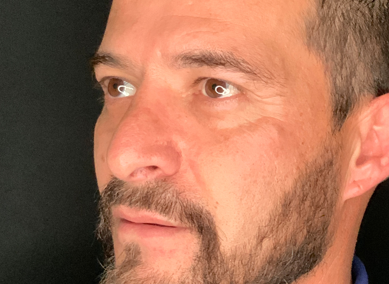 Patient #11645: Rhinoplasty After Image