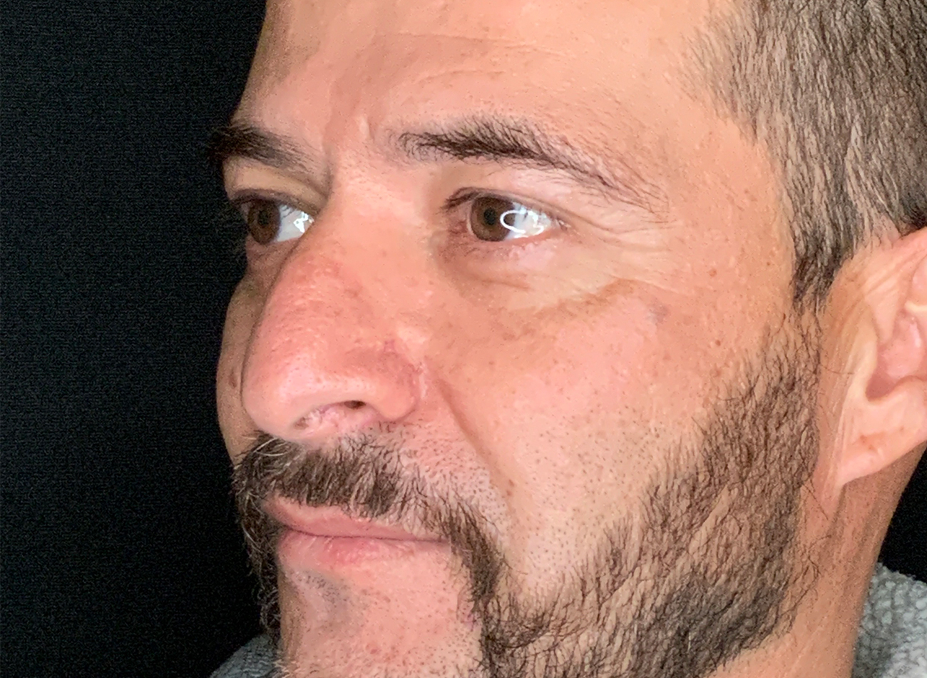 Patient #11645: Rhinoplasty Before Image