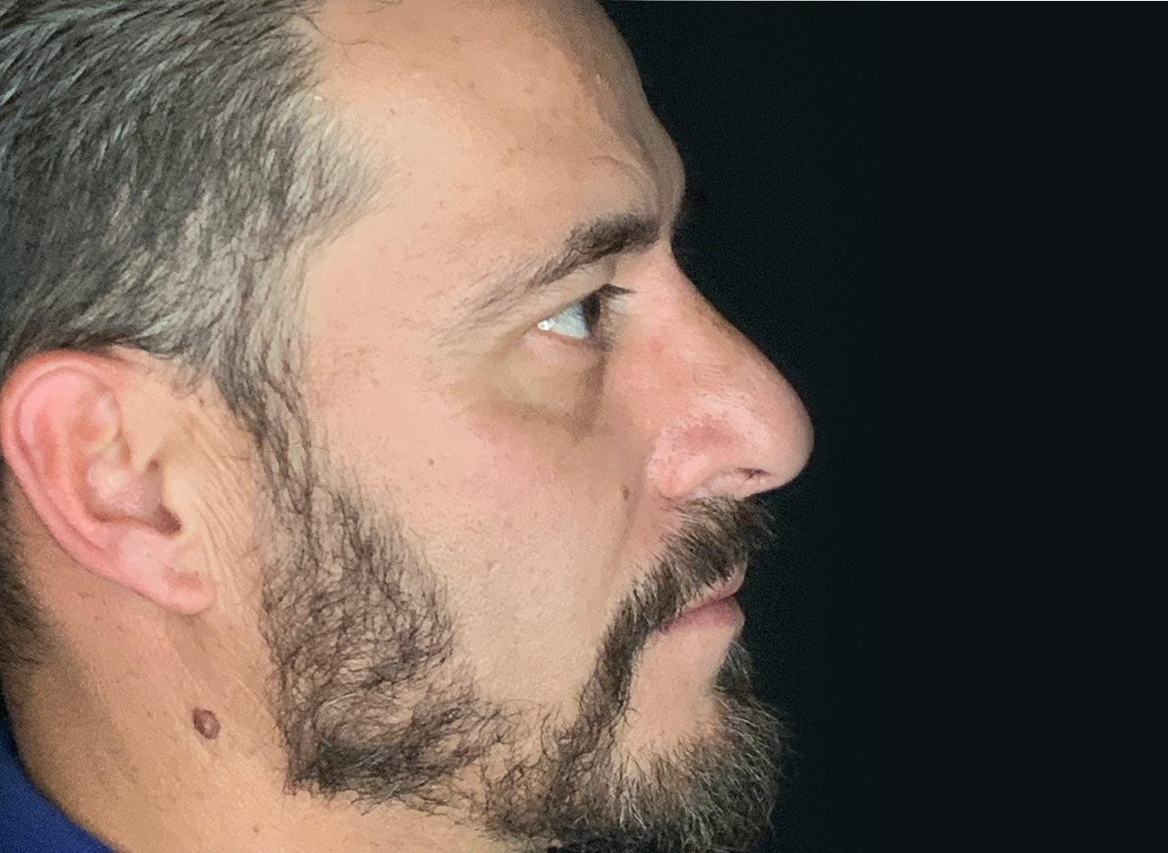 Patient #11645: Rhinoplasty After Image