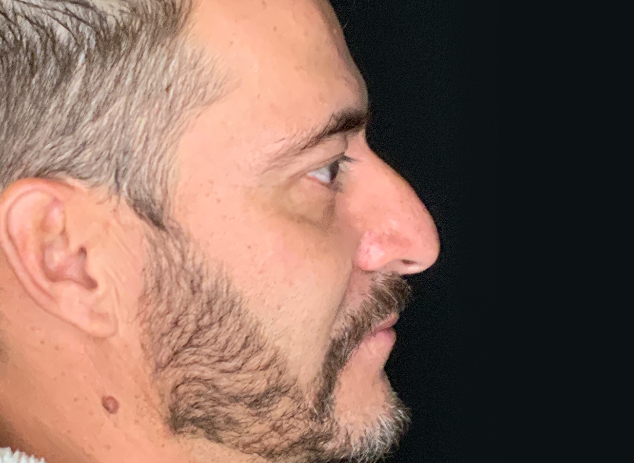 Patient #11645: Rhinoplasty Before Image