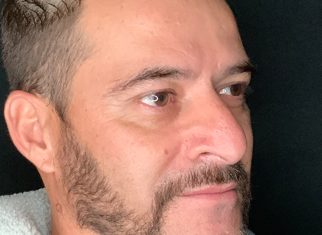 Patient #11645: Rhinoplasty Before Image