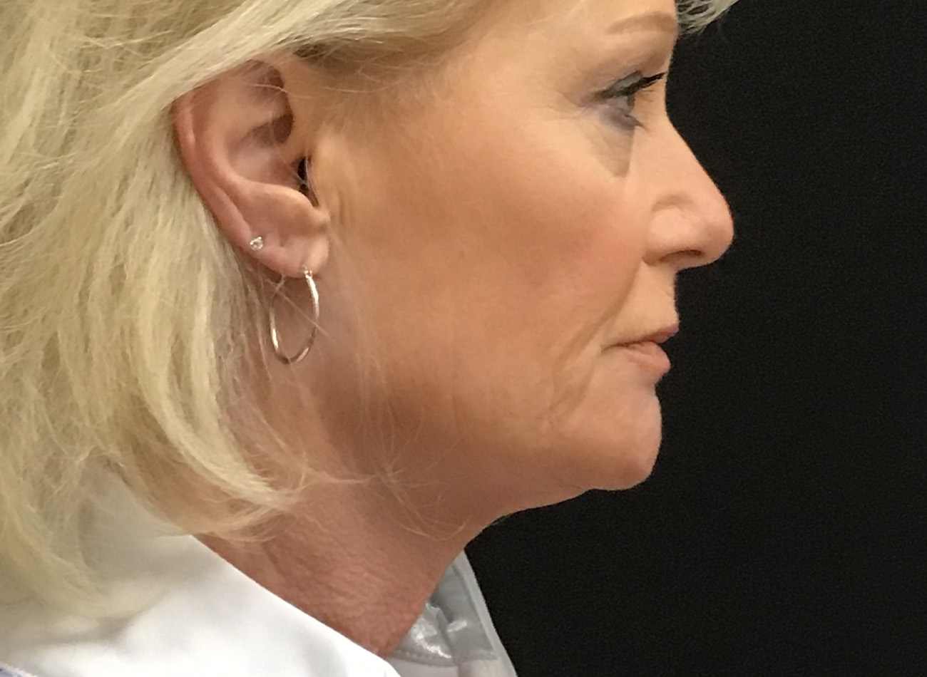 Patient #79276: Vollure & Volbella After Image