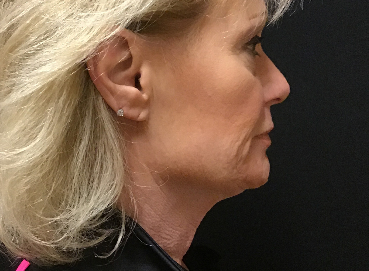 Patient #79276: Vollure & Volbella Before Image