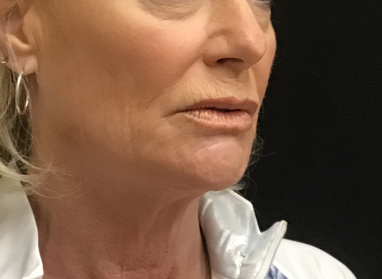 Patient #79276: Vollure & Volbella After Image