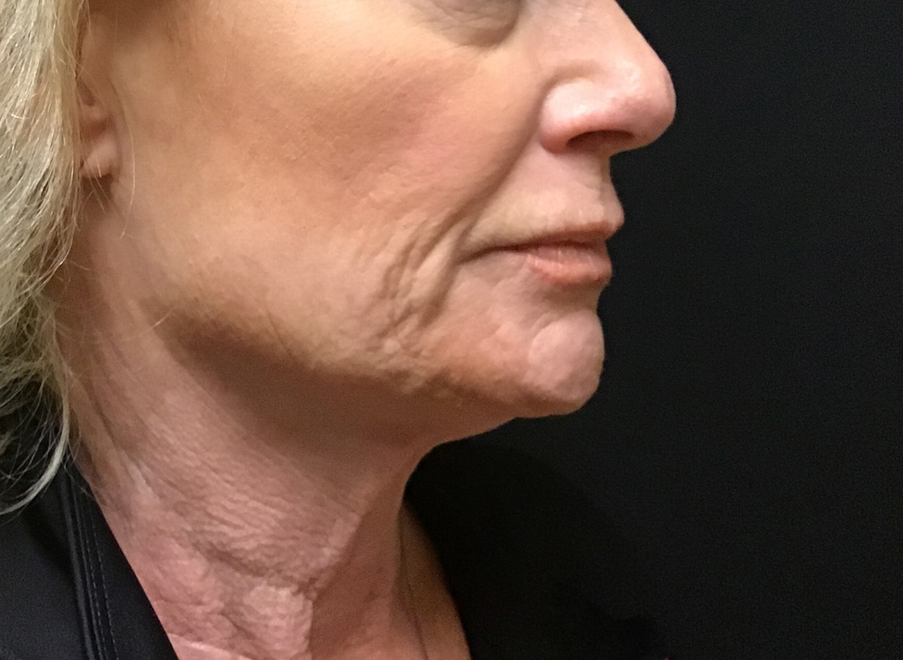 Patient #79276: Vollure & Volbella Before Image