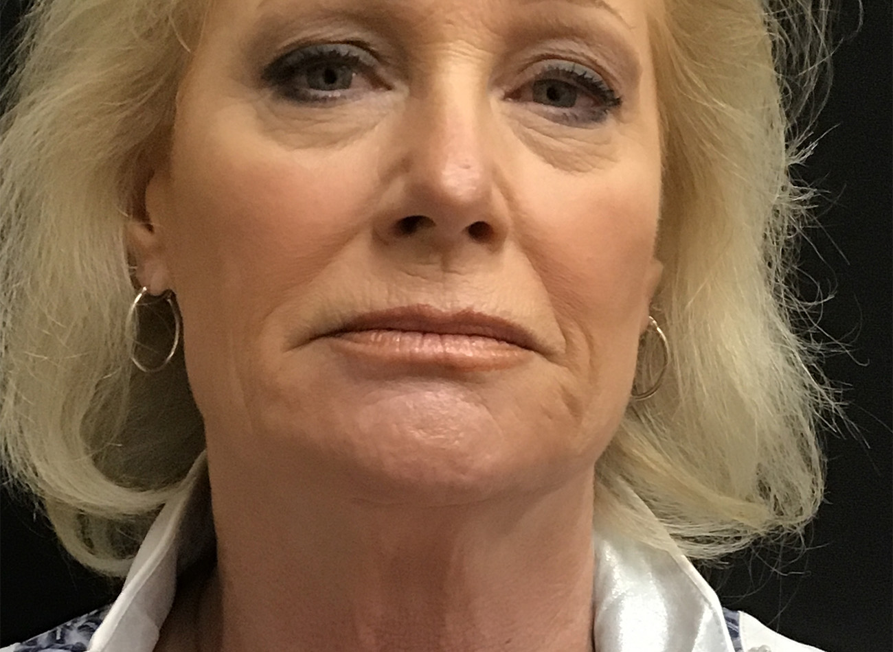 Patient #79276: Vollure & Volbella After Image