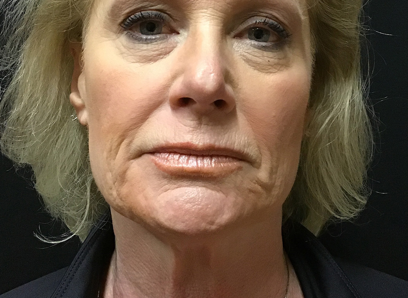 Patient #79276: Vollure & Volbella Before Image