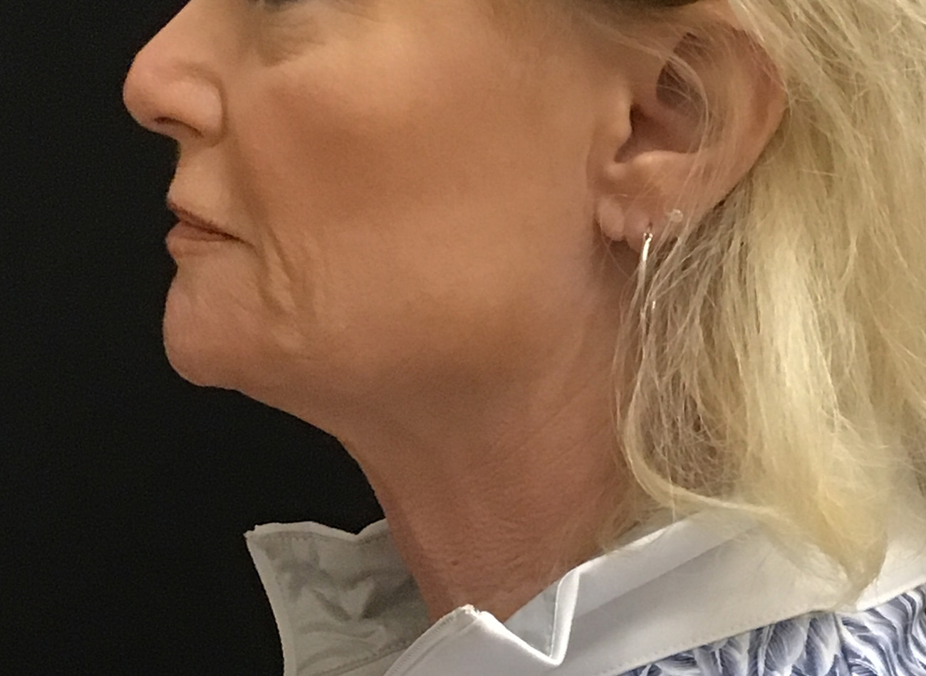 Patient #79276: Vollure & Volbella After Image