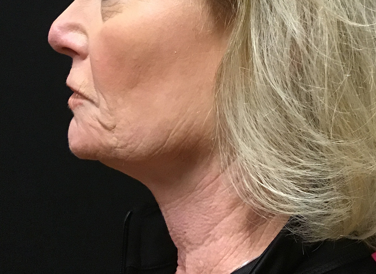 Patient #79276: Vollure & Volbella Before Image