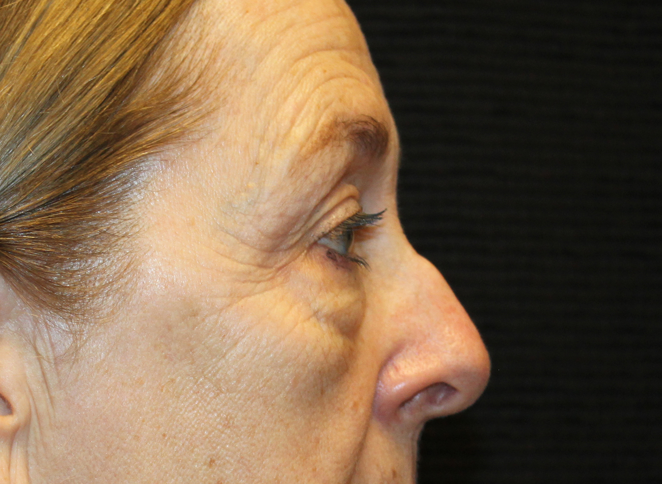 Patient #78573-2: Blepharoplasty & Browlift Before Image
