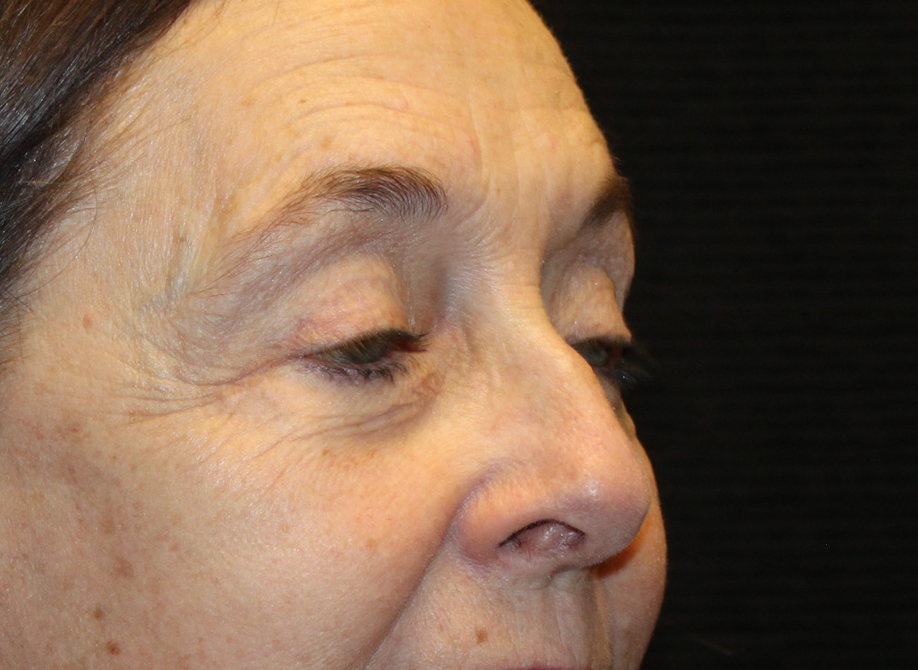 Patient #78573-2: Blepharoplasty & Browlift After Image