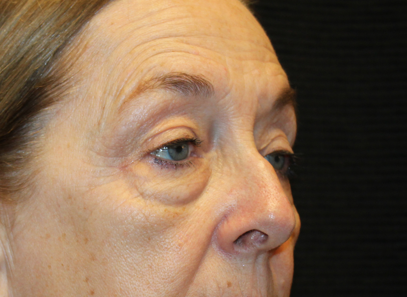 Patient #78573-2: Blepharoplasty & Browlift Before Image