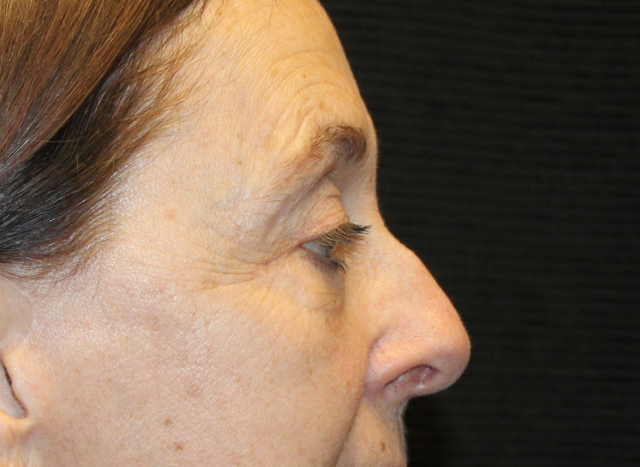 Patient #78573-2: Blepharoplasty & Browlift After Image