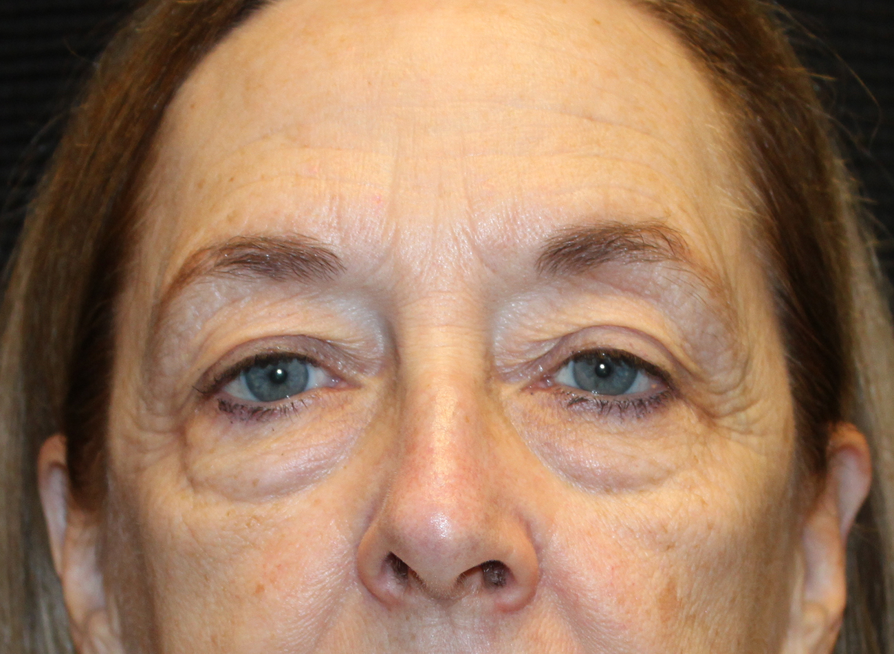 Patient #78573-2: Blepharoplasty & Browlift Before Image