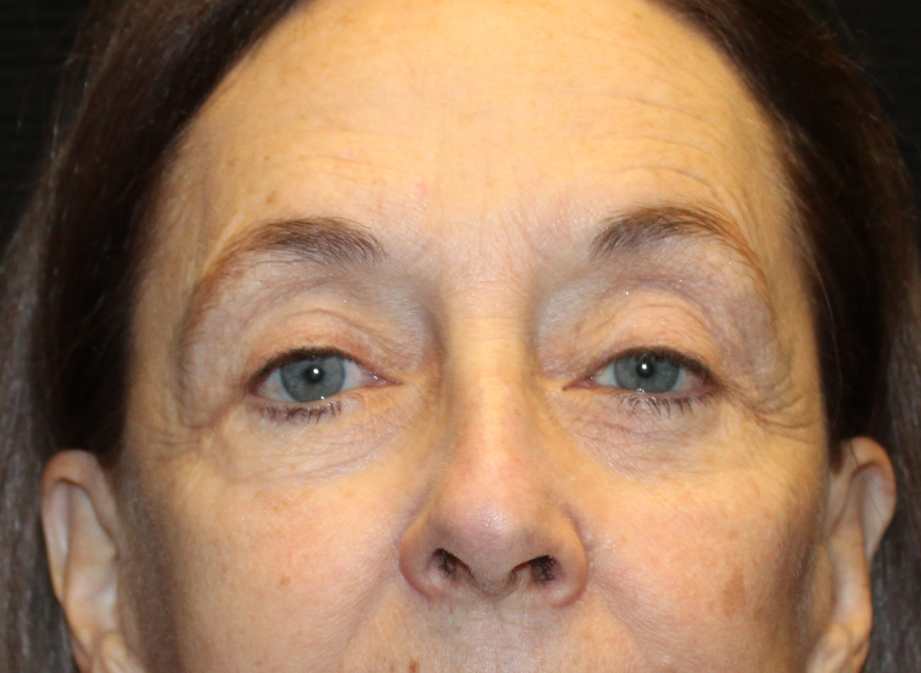 Patient #78573-2: Blepharoplasty & Browlift After Image