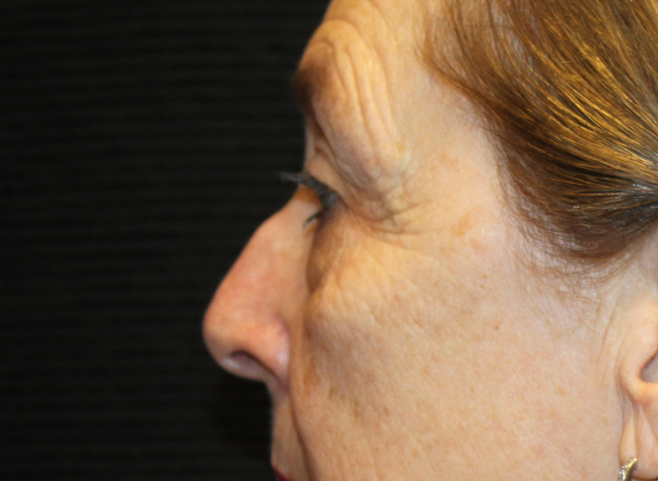 Patient #78573-2: Blepharoplasty & Browlift Before Image