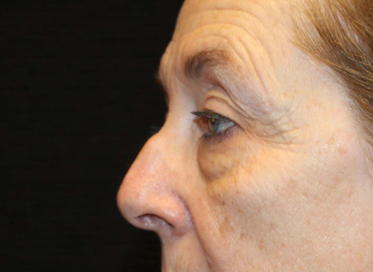 Patient #78573-2: Blepharoplasty & Browlift Before Image
