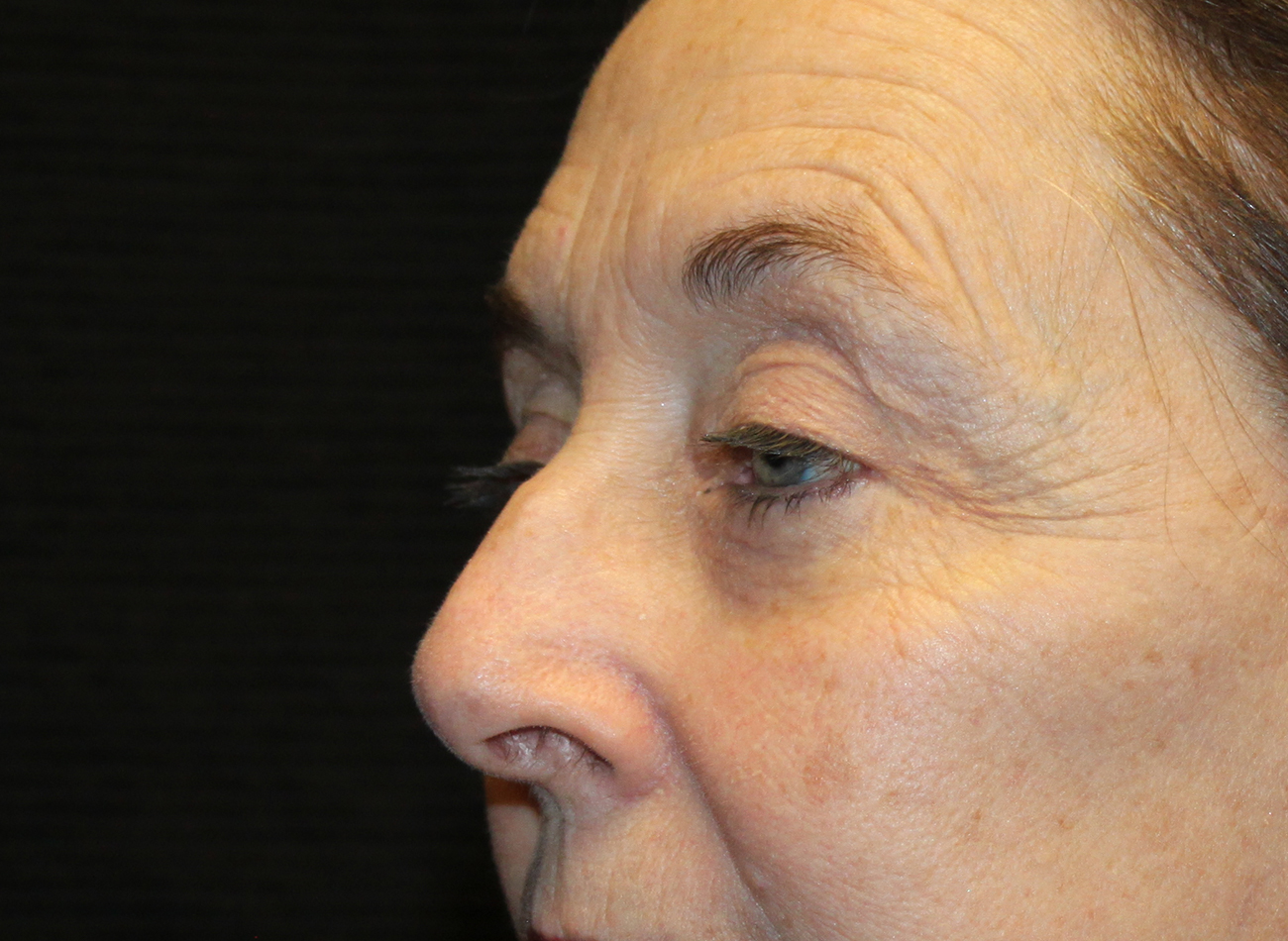 Patient #78573-2: Blepharoplasty & Browlift After Image