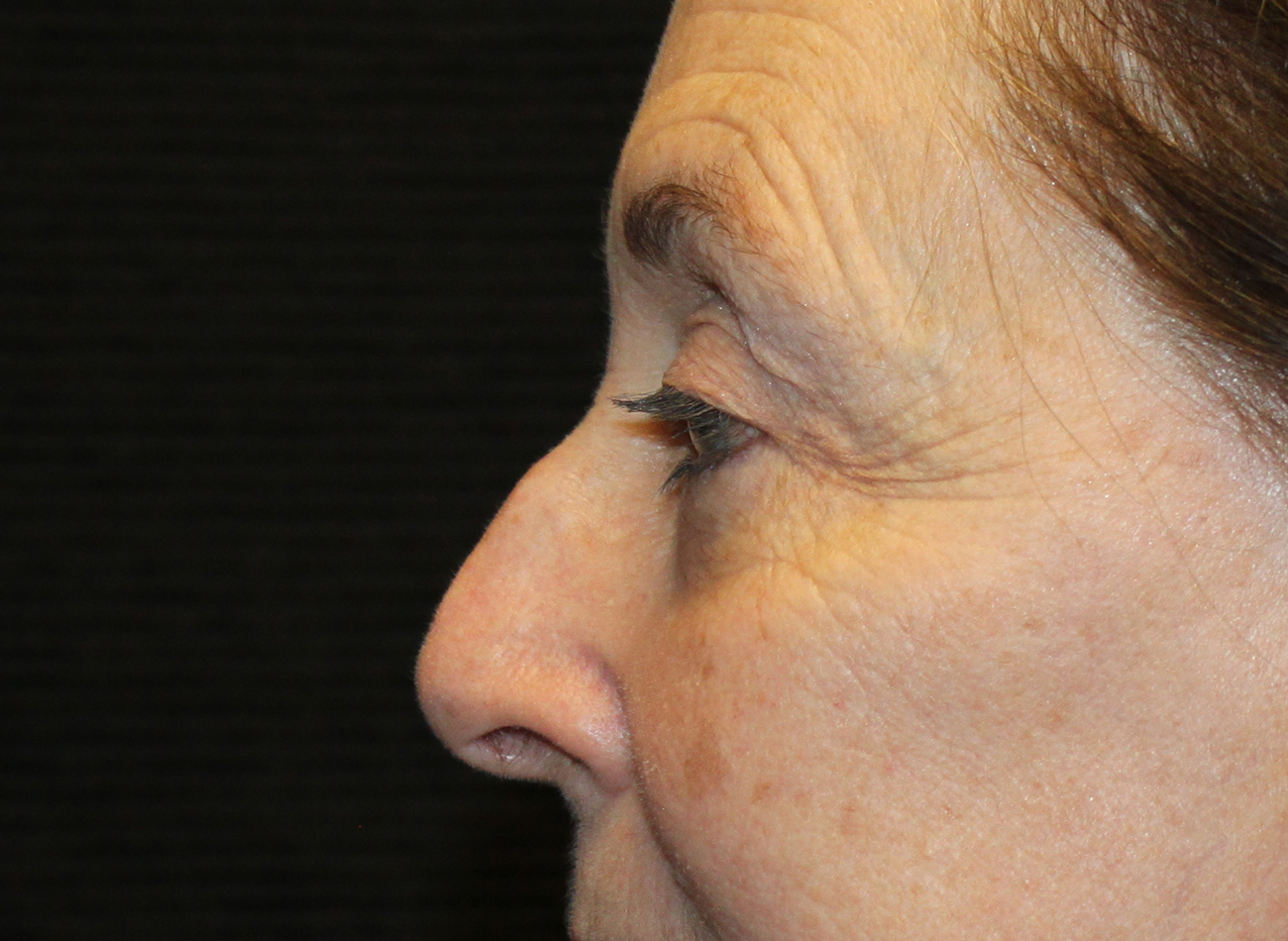Patient #78573-2: Blepharoplasty & Browlift After Image