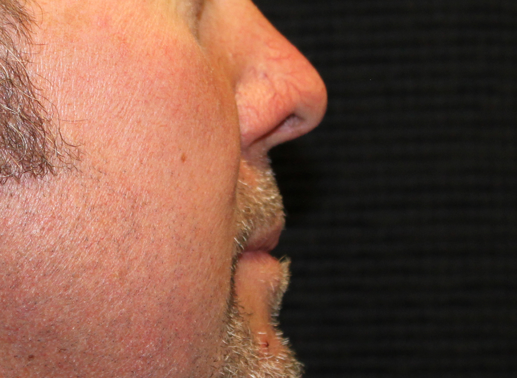 Patient #19642: IPL for Blood Vessels Before Image