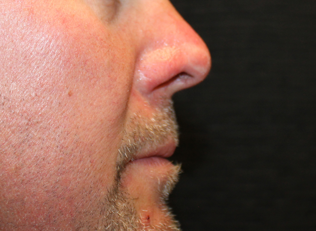 Patient #19642: IPL for Blood Vessels After Image