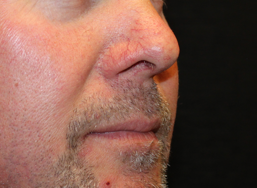 Patient #19642: IPL for Blood Vessels Before Image