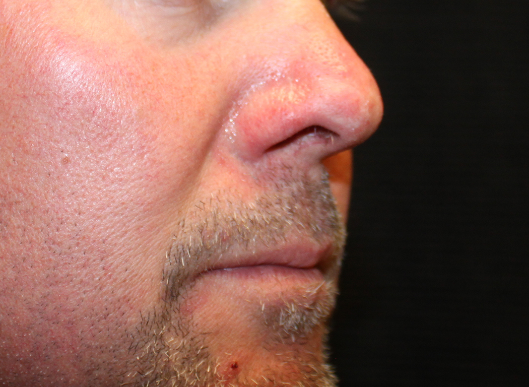 Patient #19642: IPL for Blood Vessels After Image