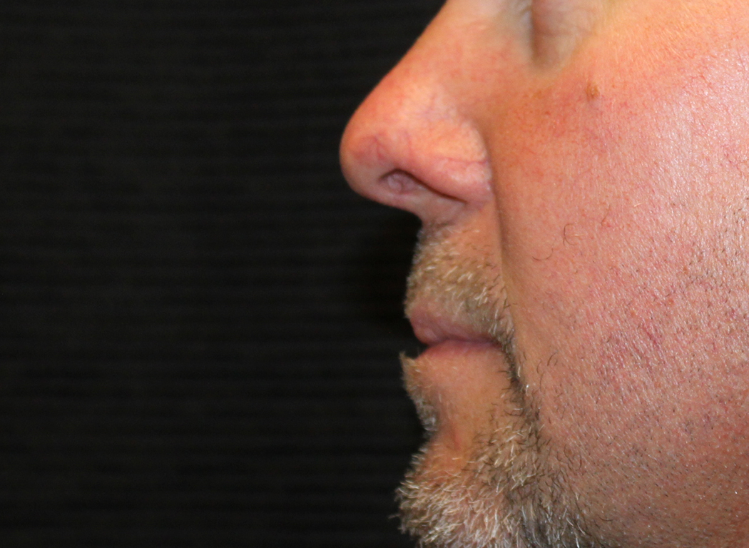 Patient #19642: IPL for Blood Vessels Before Image