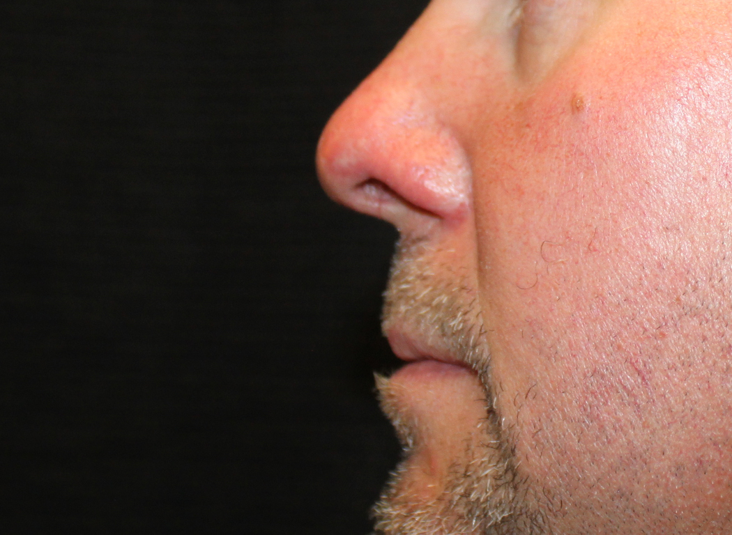 Patient #19642: IPL for Blood Vessels After Image