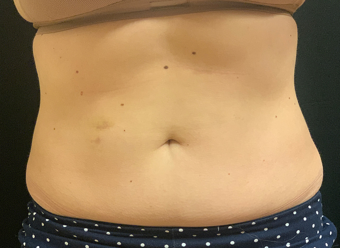 Patient #43556: CoolSculpting After Image