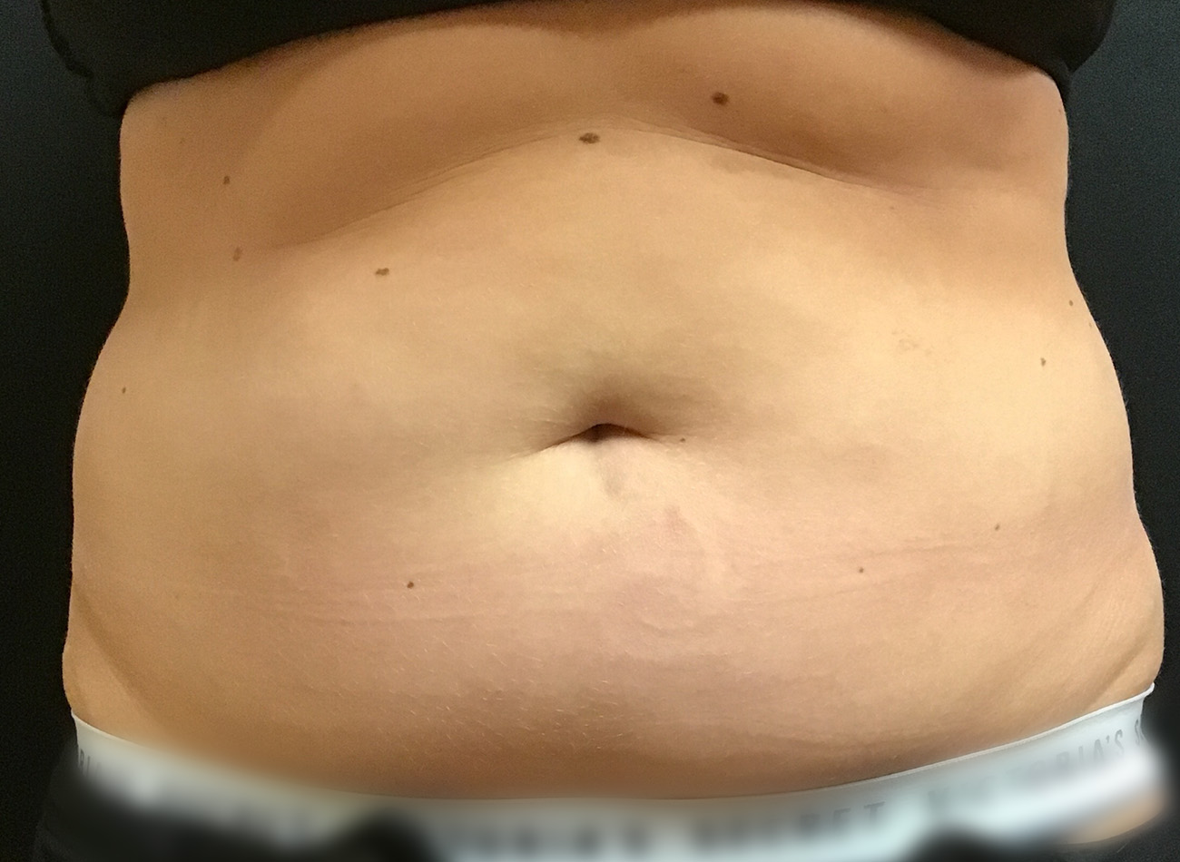 Patient #43556: CoolSculpting Before Image