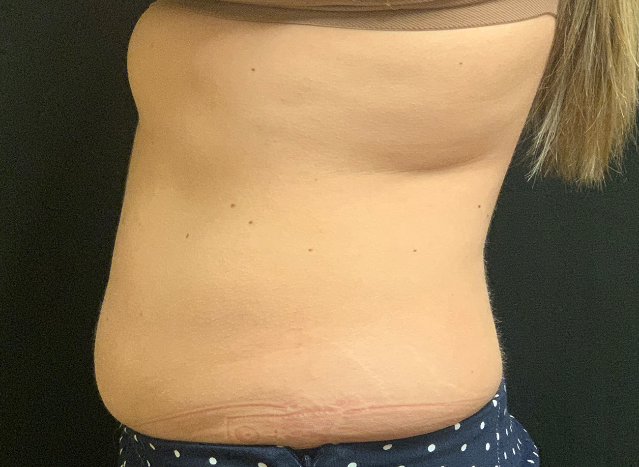 Patient #43556: CoolSculpting After Image