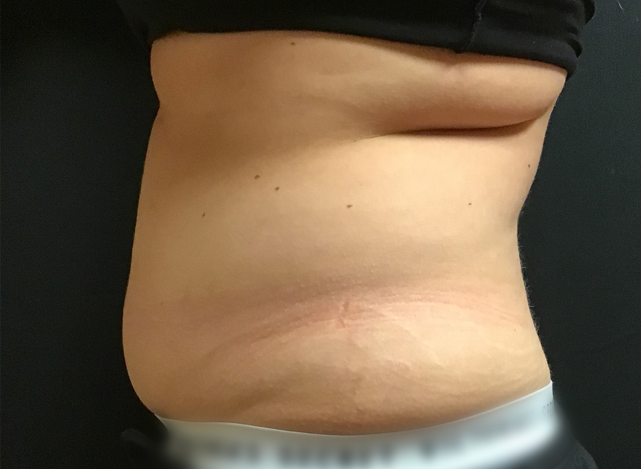 Patient #43556: CoolSculpting Before Image