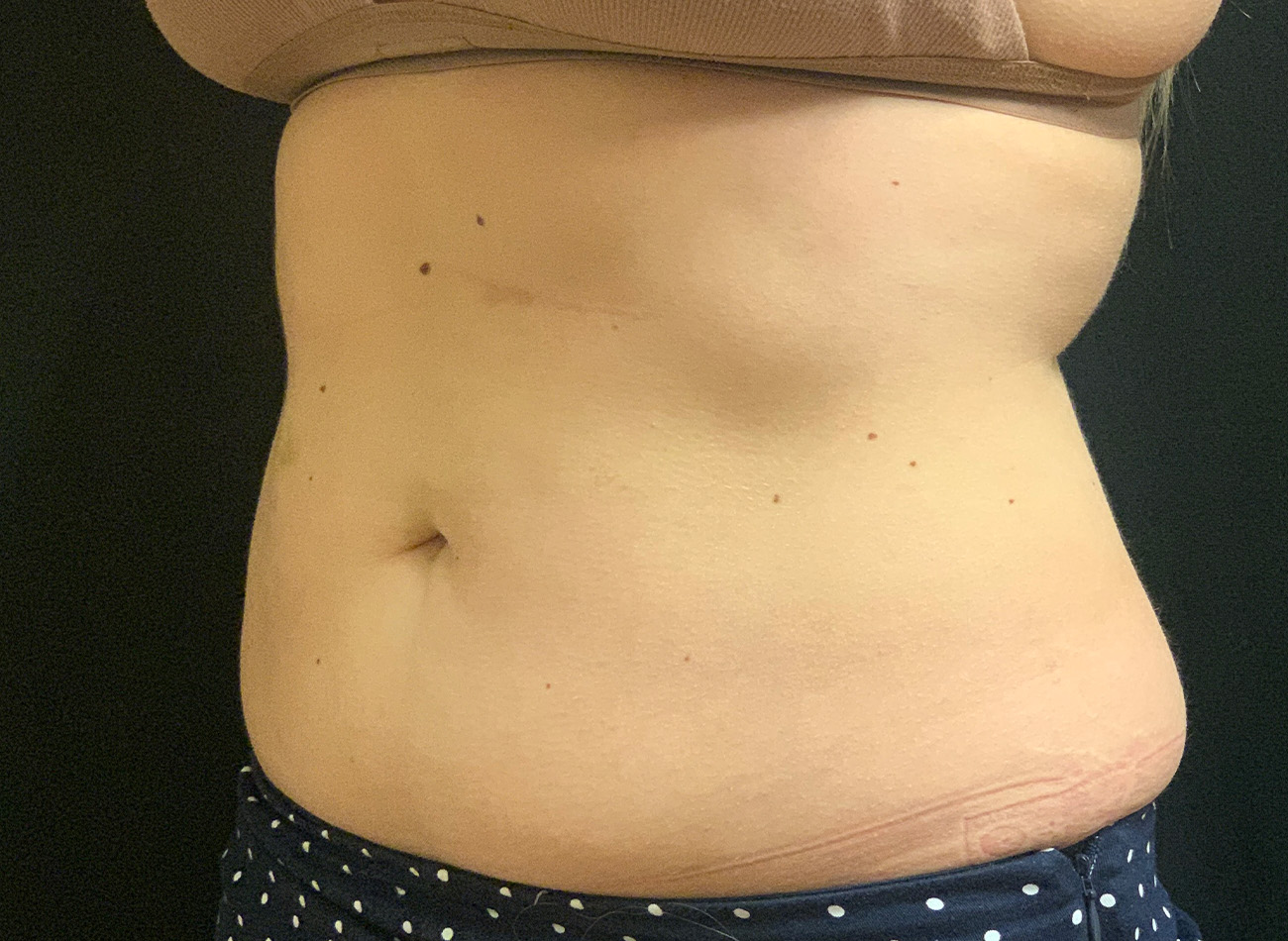 Patient #43556: CoolSculpting After Image