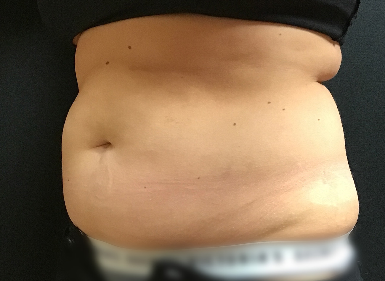 Patient #43556: CoolSculpting Before Image