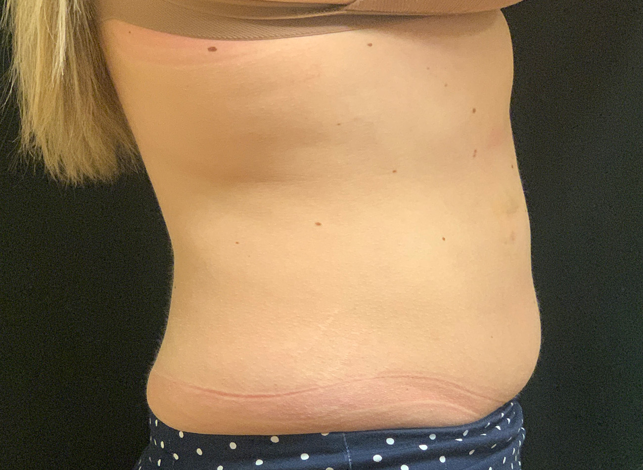 Patient #43556: CoolSculpting After Image