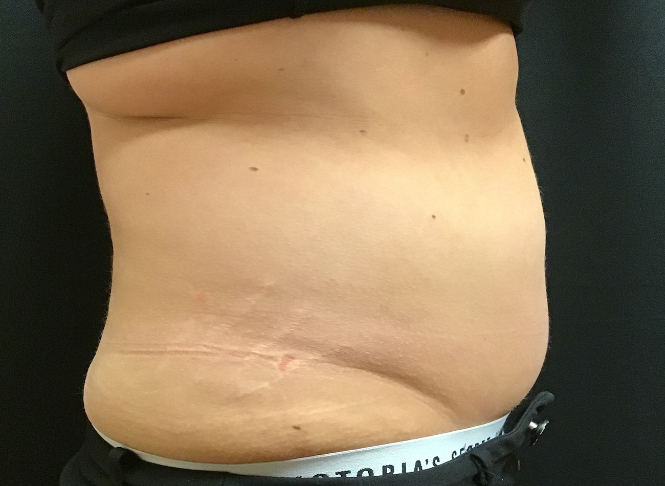 Patient #43556: CoolSculpting Before Image