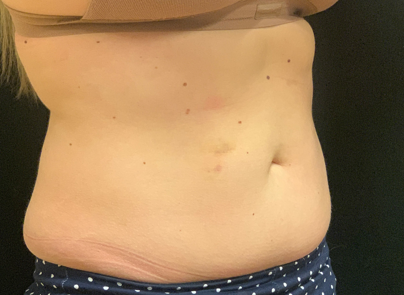 Patient #43556: CoolSculpting After Image