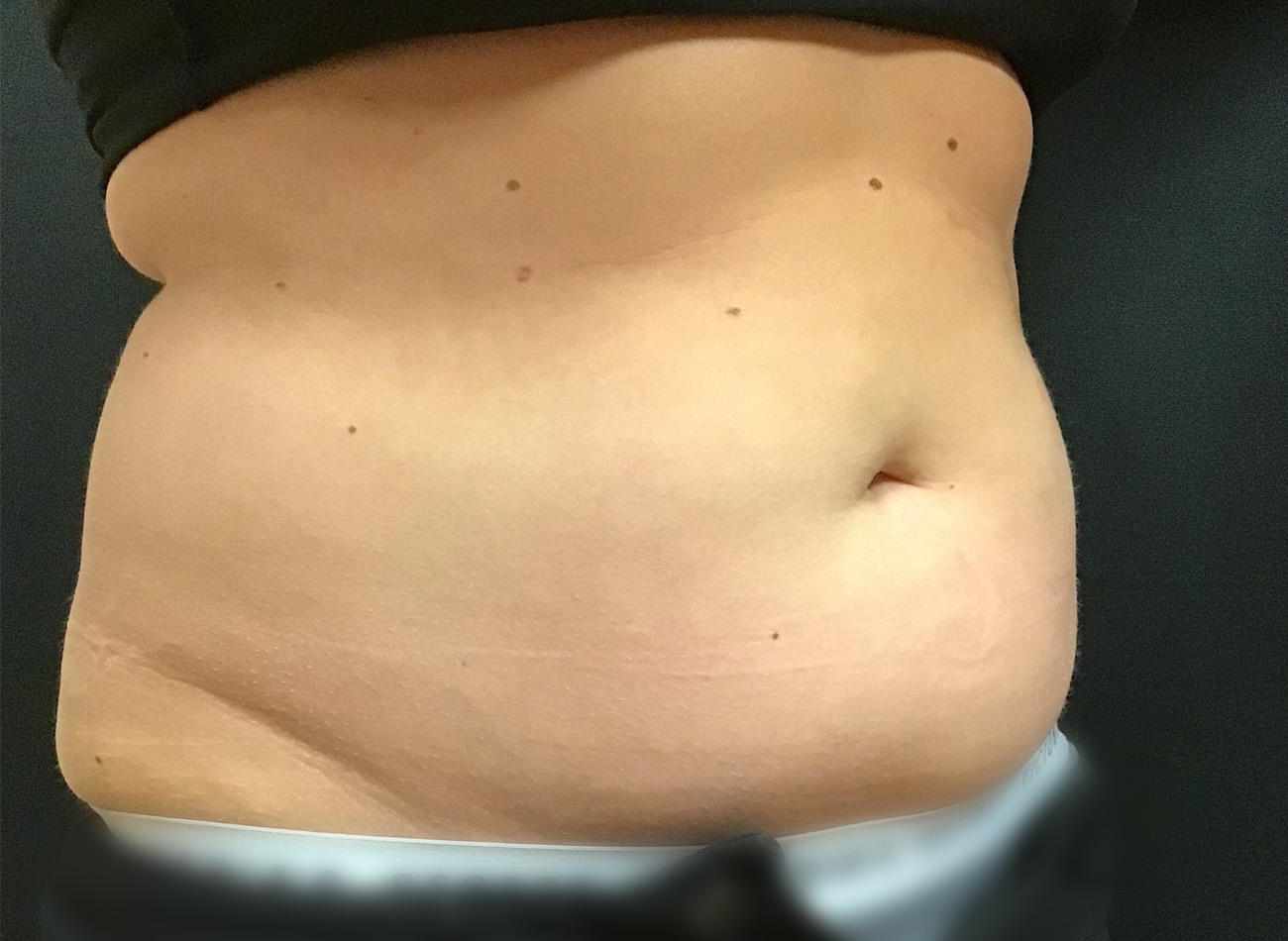 Patient #43556: CoolSculpting Before Image