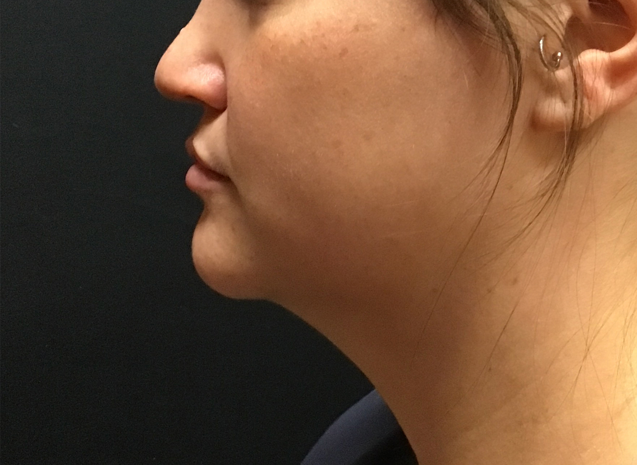 Patient #58314: CoolSculpting After Image