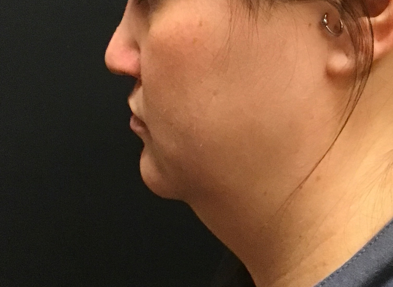 Patient #58314: CoolSculpting Before Image