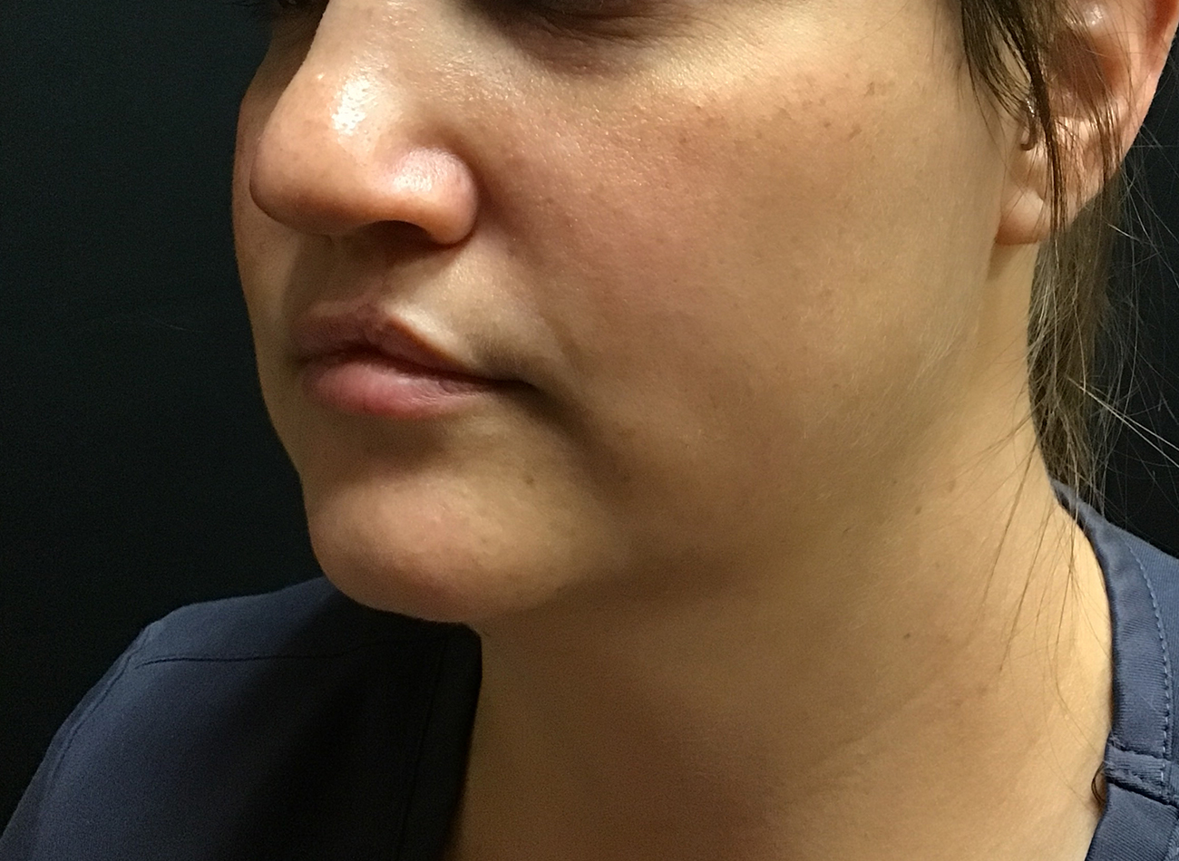 Patient #58314: CoolSculpting After Image