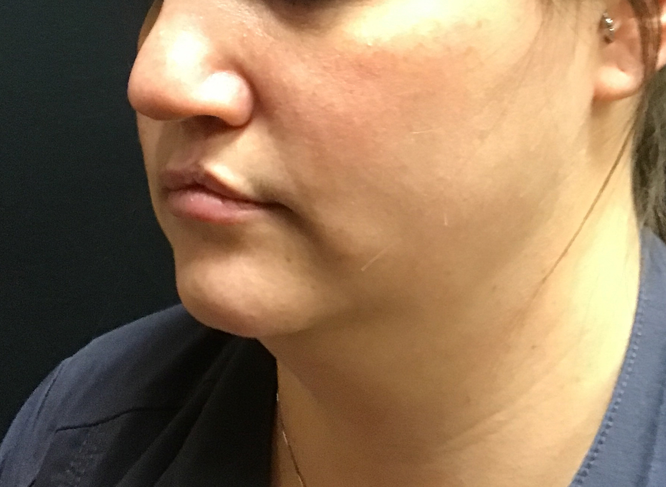 Patient #58314: CoolSculpting Before Image