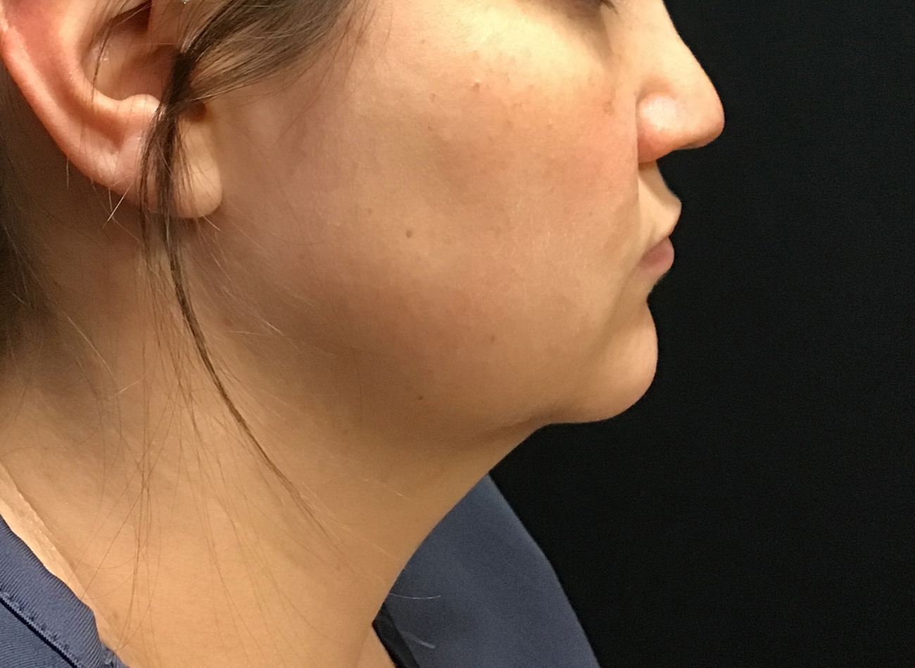 Patient #58314: CoolSculpting After Image