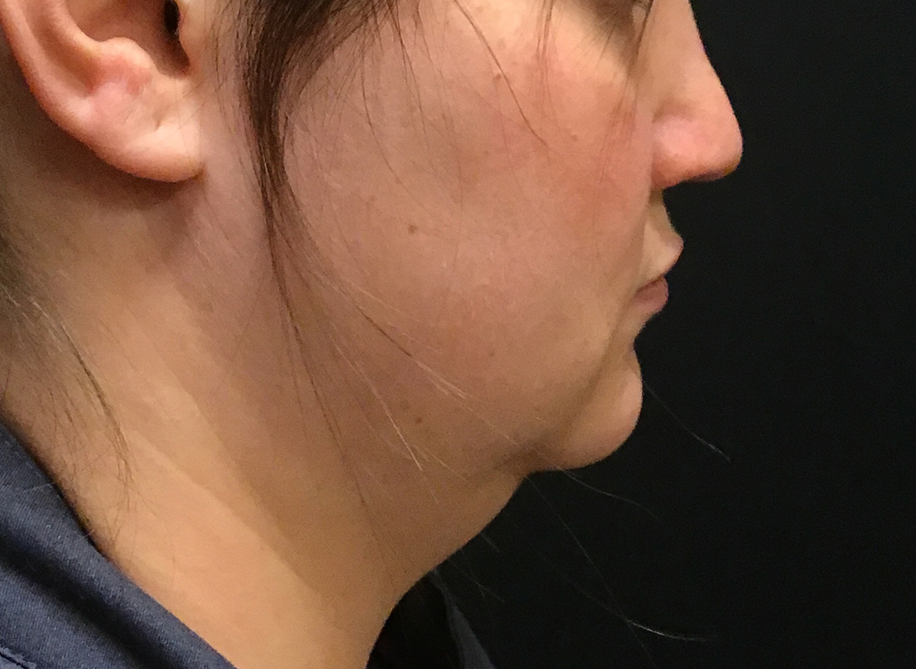 Patient #58314: CoolSculpting Before Image