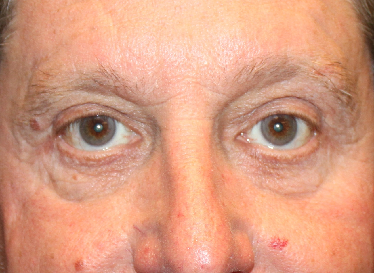 Patient #12832: Bilateral Upper & Lower Blepharoplasty After Image