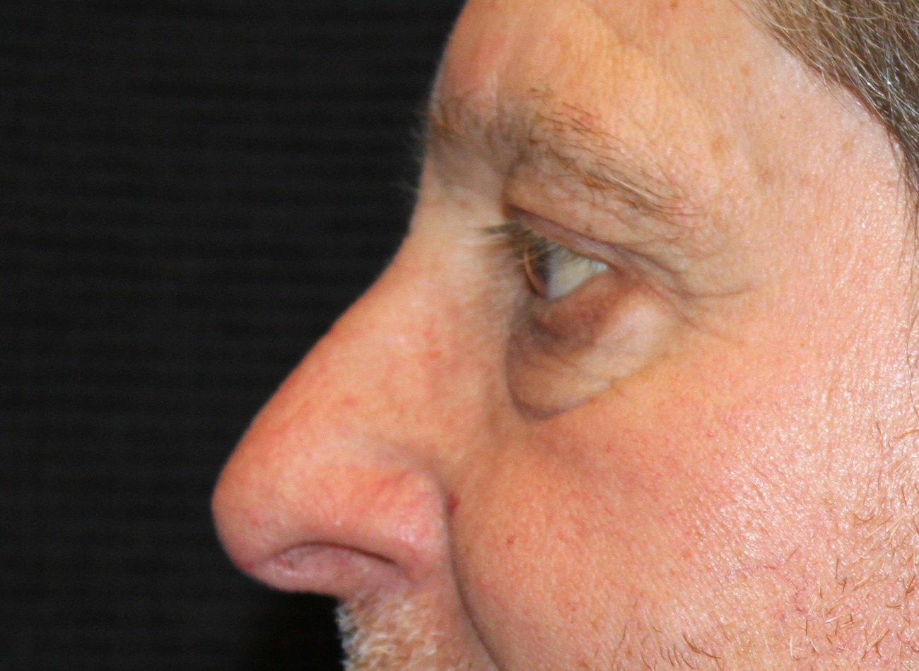 Patient #12832: Bilateral Upper & Lower Blepharoplasty Before Image