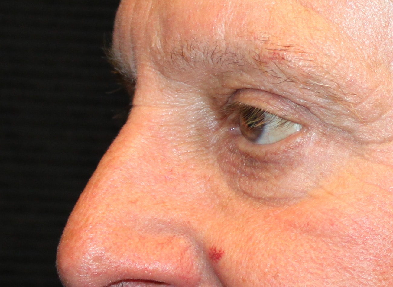 Patient #12832: Bilateral Upper & Lower Blepharoplasty After Image